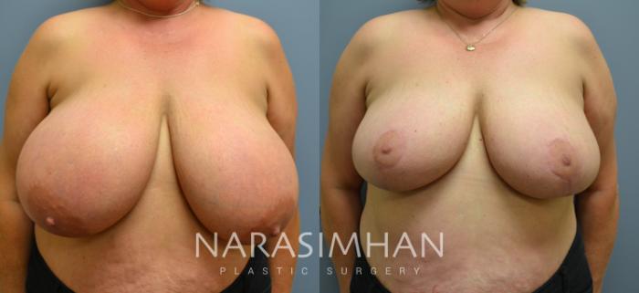 Before & After Breast Reduction Case 45 View #1 View in Tampa, Florida