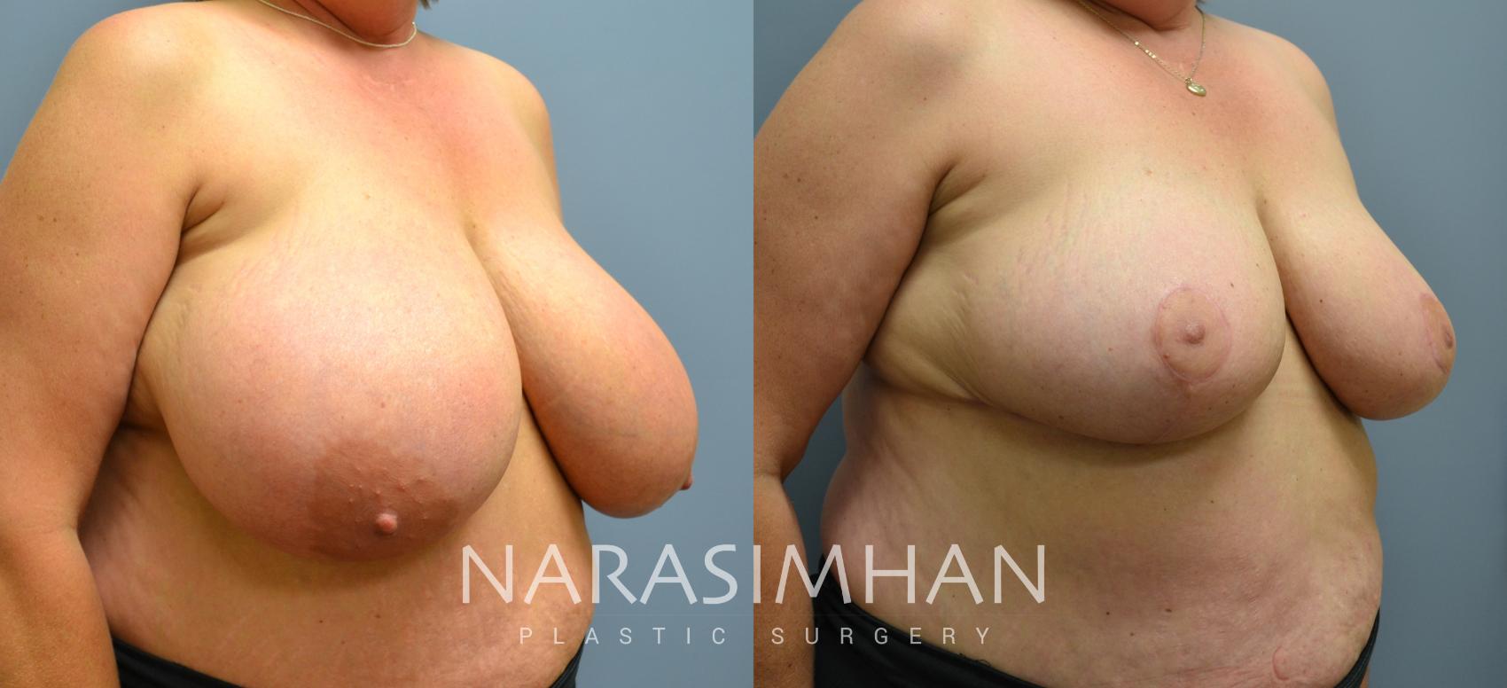 Before & After Breast Reduction Case 45 View #2 View in St. Petersburg, Florida