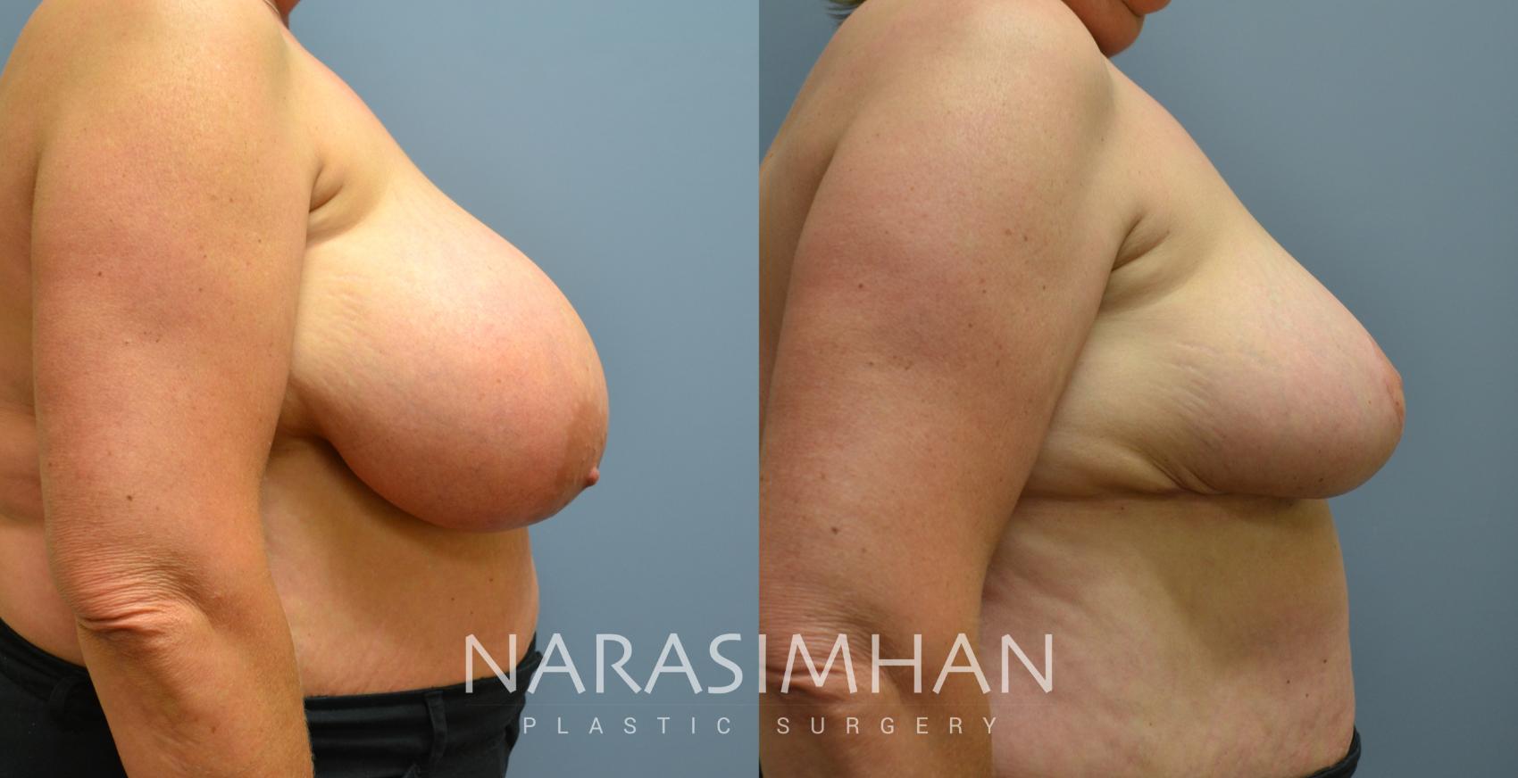 Before & After Breast Reduction Case 45 View #3 View in St. Petersburg, Florida