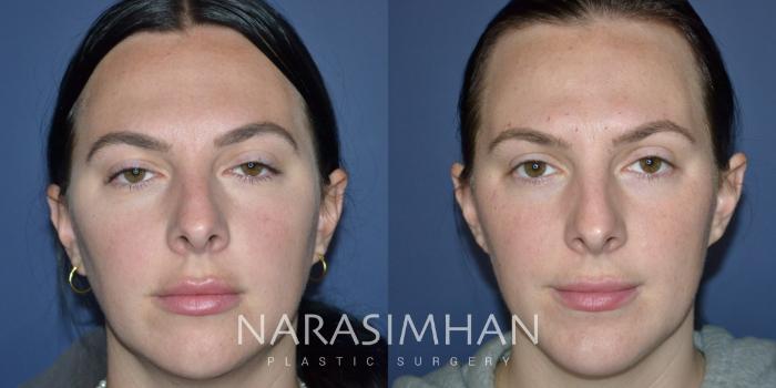 Before & After Chin Augmentation  Case 331 Front View in Tampa, Florida