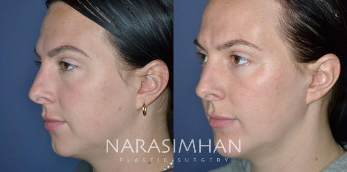 Before & After Chin Augmentation  Case 331 Left Oblique View in Tampa, Florida