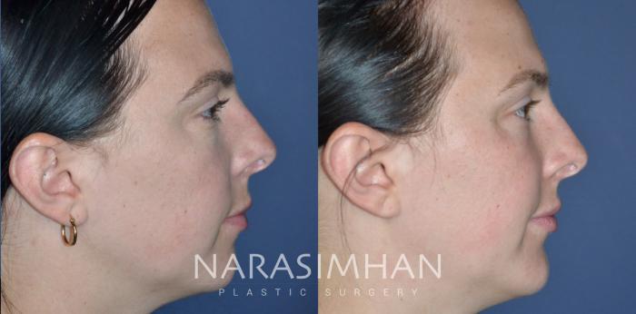 Before & After Chin Augmentation  Case 331 Right Side View in Tampa, Florida