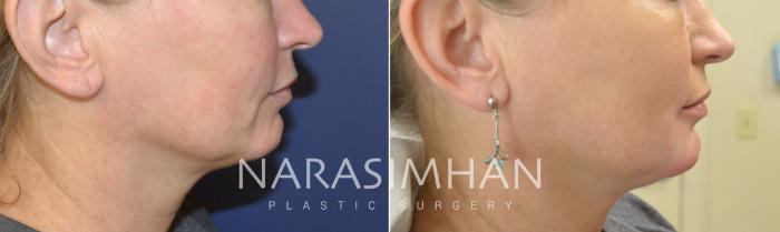 Before & After Chin Augmentation  Case 98 View #1 View in Tampa, Florida