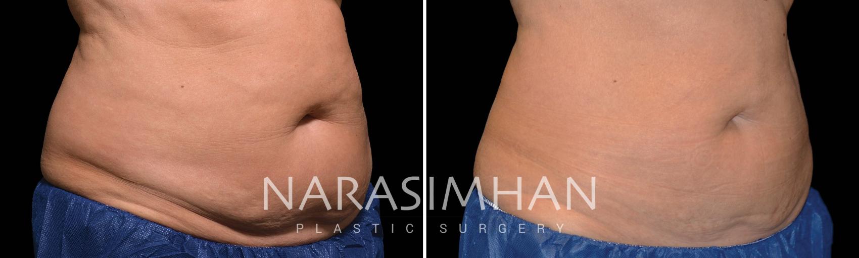 Before & After Coolsculpting Case 212 View #1 View in St Petersburg, Florida