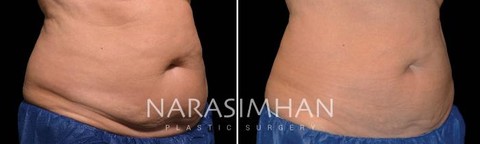 Before & After Coolsculpting Case 212 View #1 View in Tampa, Florida