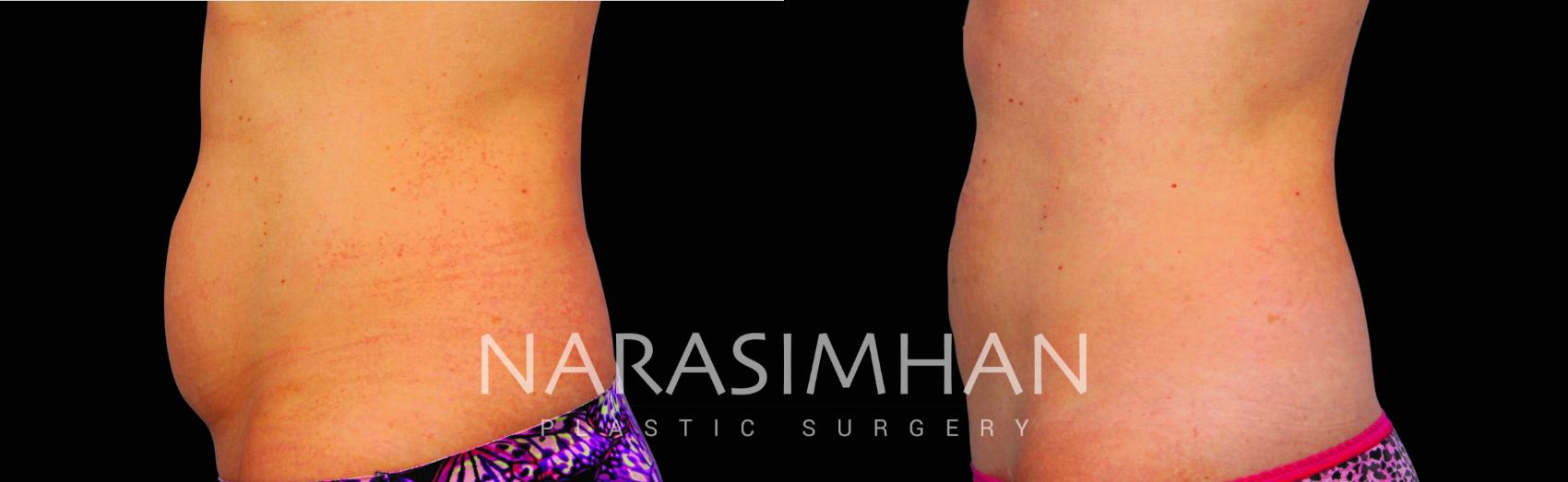 Before & After Coolsculpting Case 214 View #1 View in St Petersburg, Florida