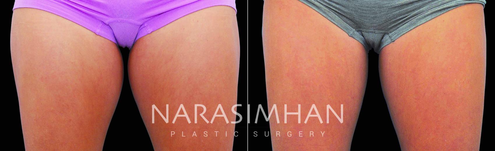 Before & After Coolsculpting Case 215 View #1 View in St Petersburg, Florida