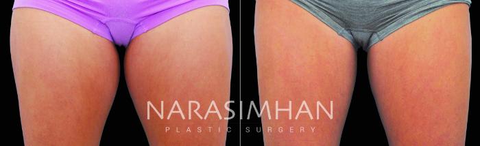 Before & After Coolsculpting Case 215 View #1 View in Tampa, Florida