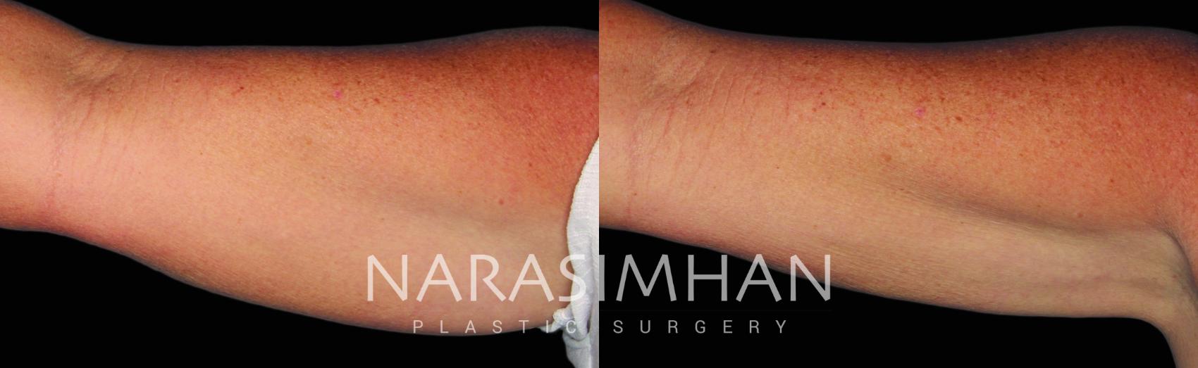 Before & After Coolsculpting Case 216 View #1 View in St Petersburg, Florida