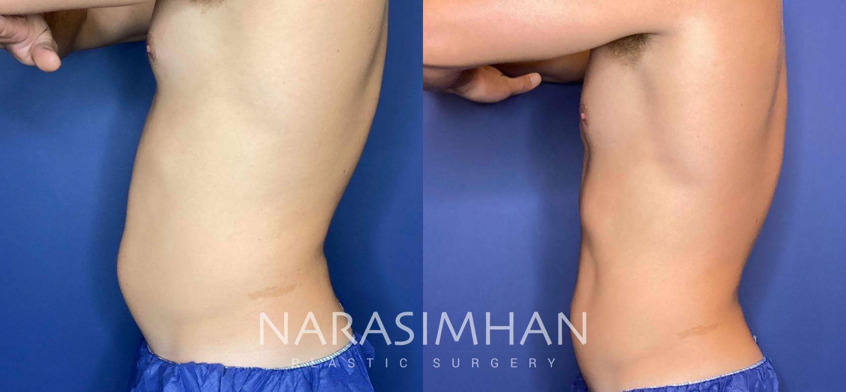 Before & After Coolsculpting Case 260 View #1 View in Tampa, Florida