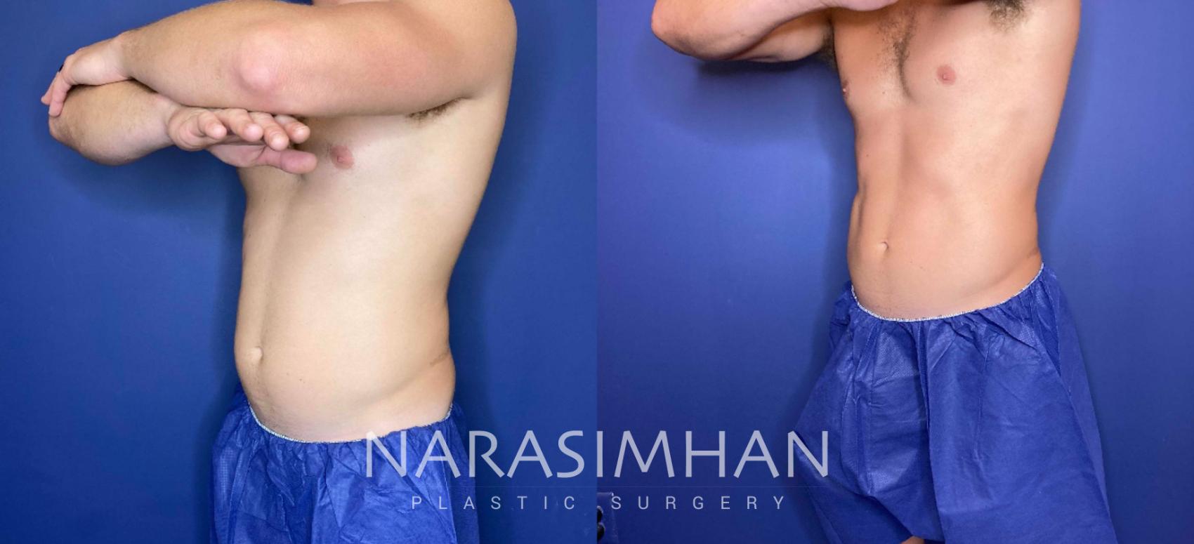 Before & After Coolsculpting Case 260 View #2 View in St Petersburg, Florida
