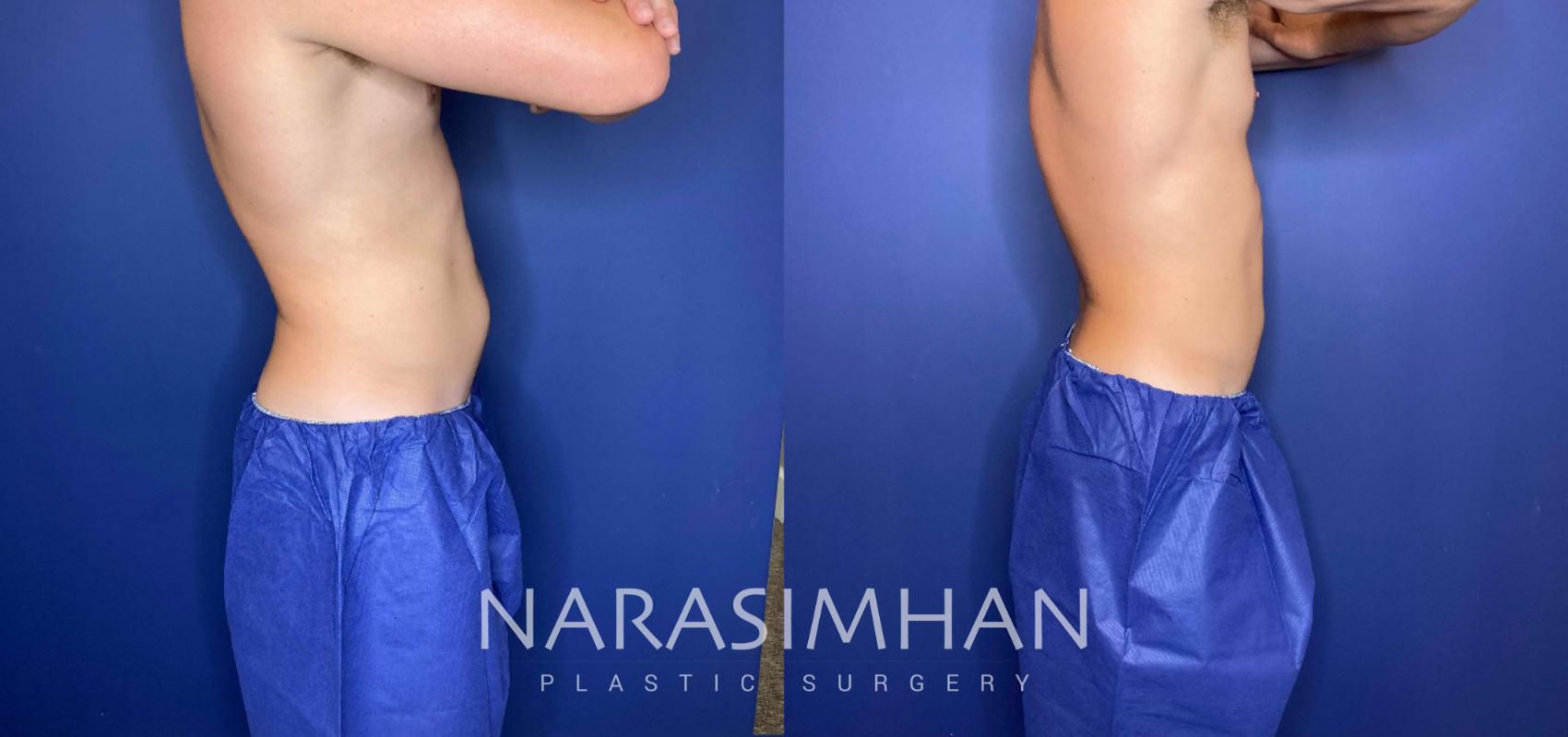 Before & After Coolsculpting Case 260 View #3 View in St Petersburg, Florida