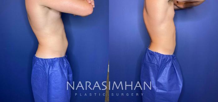 Before & After Coolsculpting Case 260 View #3 View in Tampa, Florida