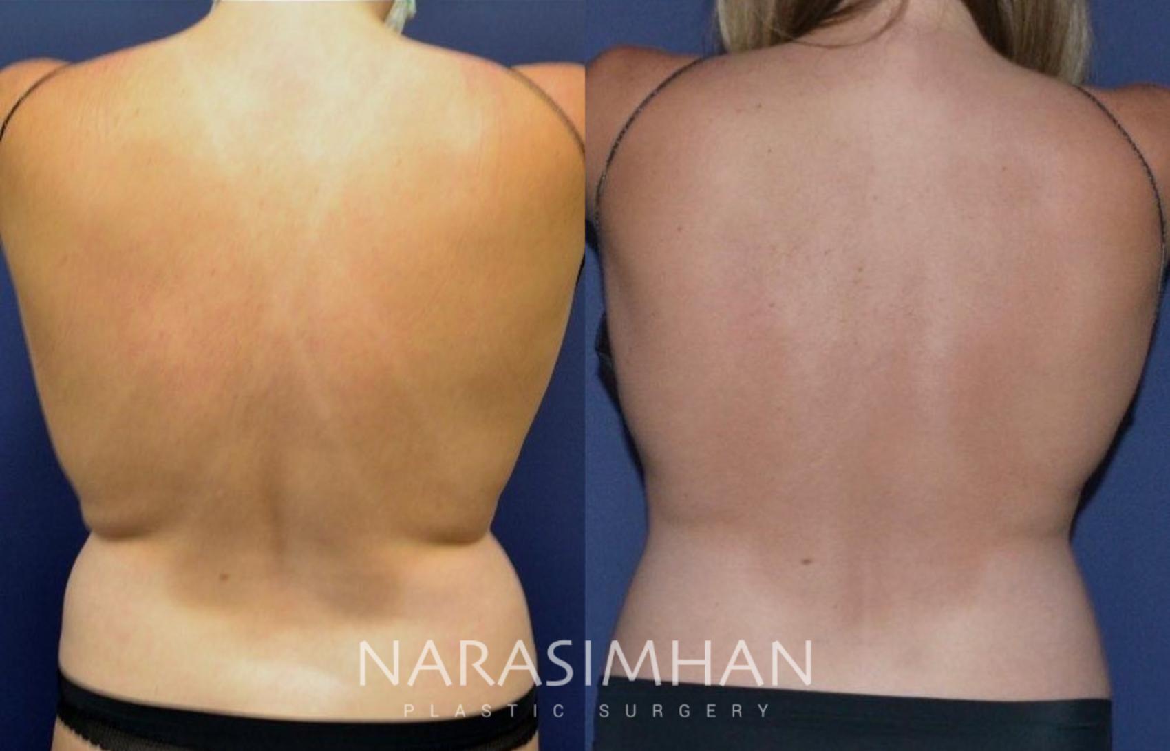 Before & After Coolsculpting Case 261 View #1 View in St Petersburg, Florida