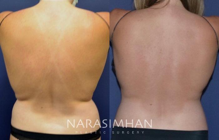 Before & After Coolsculpting Case 261 View #1 View in Tampa, Florida