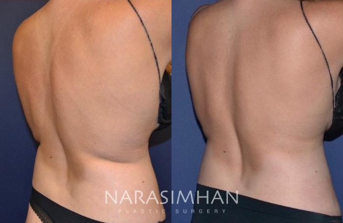Before & After Coolsculpting Case 261 View #2 View in Tampa, Florida