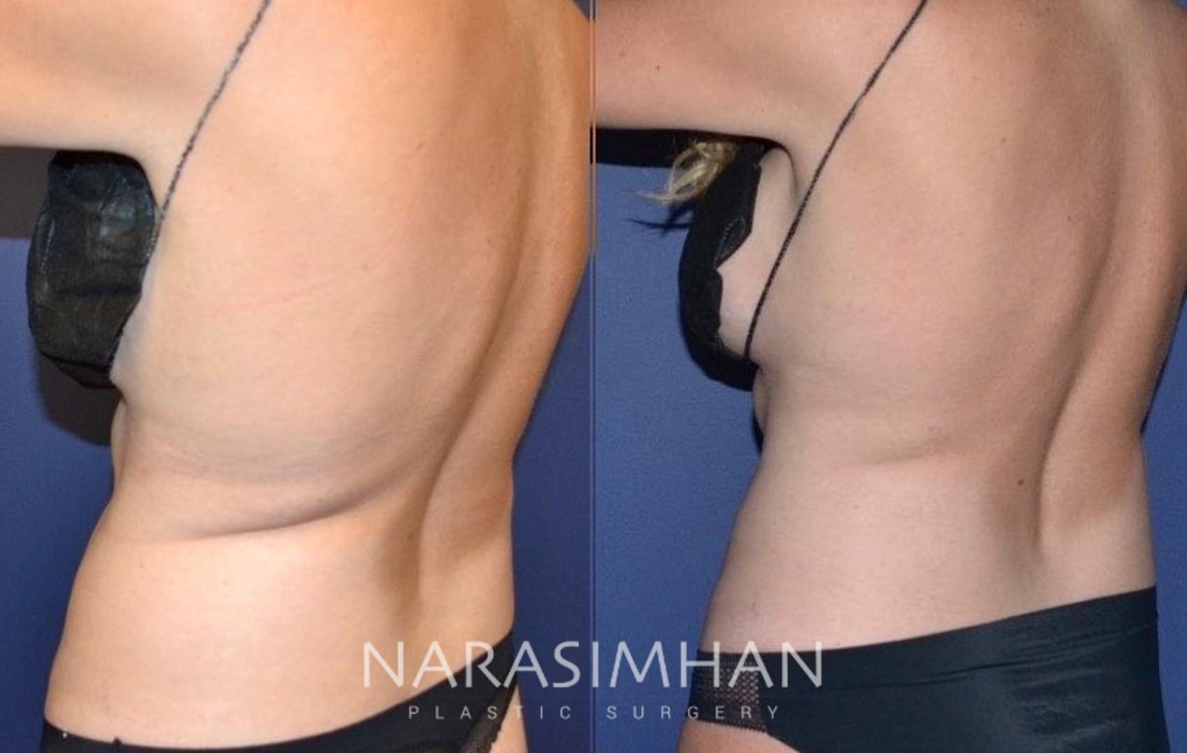 Before & After Coolsculpting Case 261 View #3 View in St Petersburg, Florida