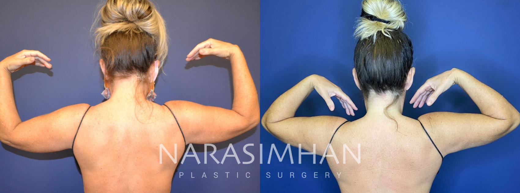 Before & After Coolsculpting Case 262 View #1 View in St. Petersburg, Florida