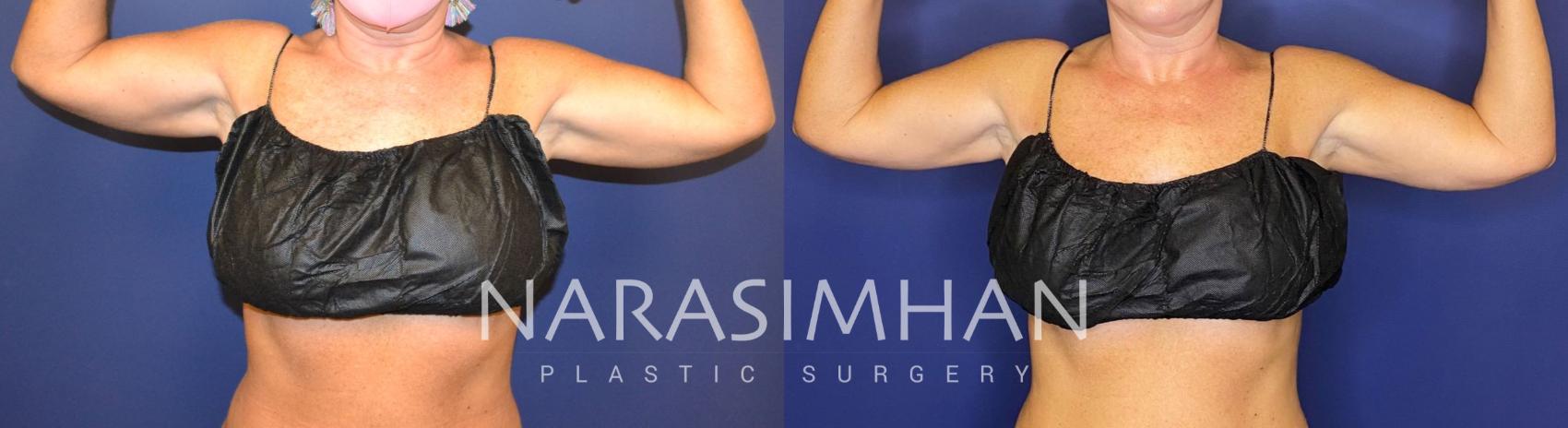 Before & After Coolsculpting Case 262 View #2 View in St Petersburg, Florida