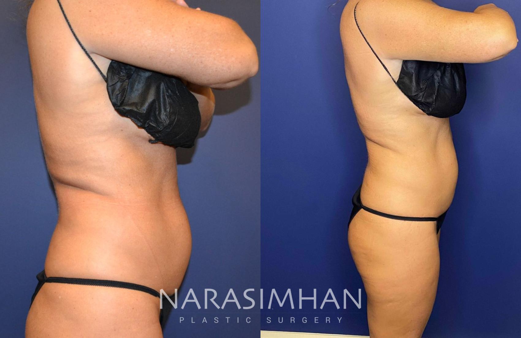 Before & After Coolsculpting Case 262 View #3 View in St Petersburg, Florida