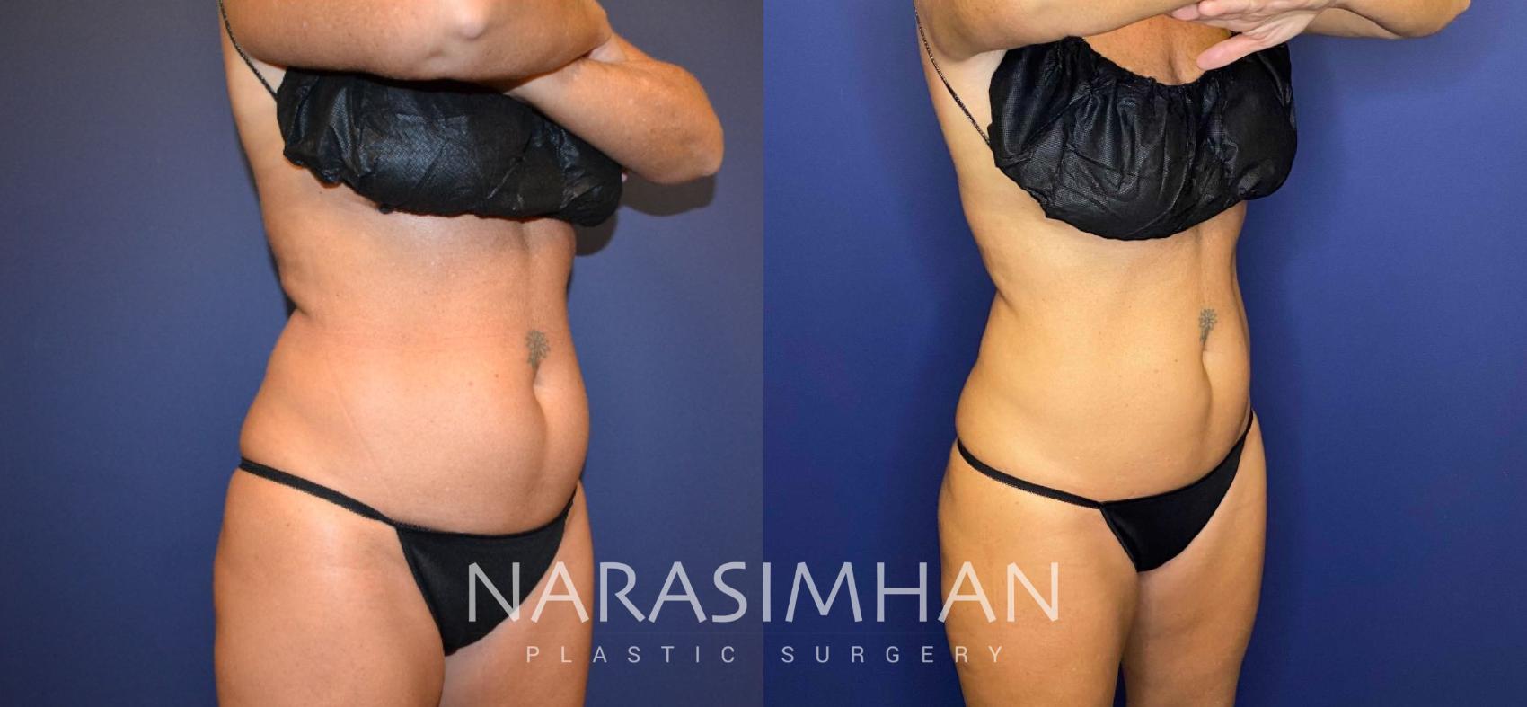 Before & After Coolsculpting Case 262 View #4 View in St Petersburg, Florida