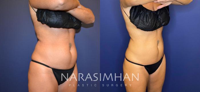 Before & After Coolsculpting Case 262 View #4 View in Tampa, Florida