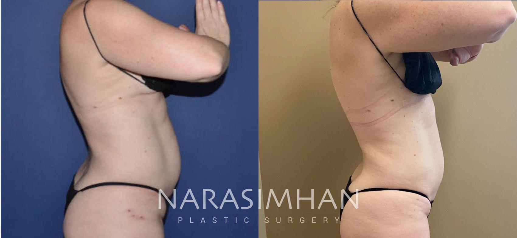 Before & After Coolsculpting Case 263 View #1 View in St Petersburg, Florida