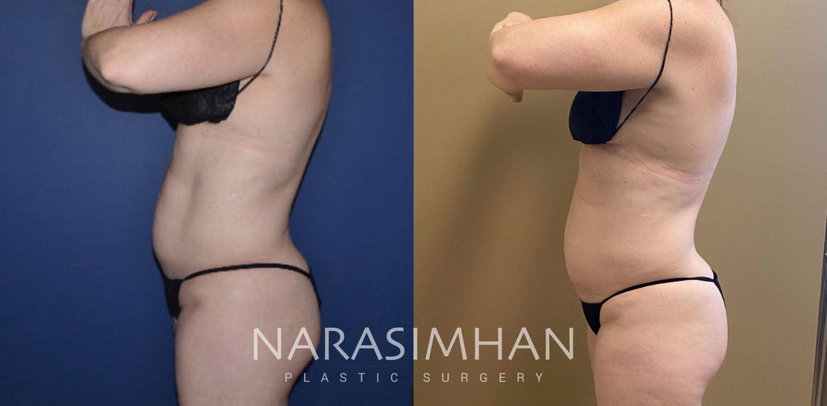 Before & After Coolsculpting Case 263 View #3 View in St Petersburg, Florida