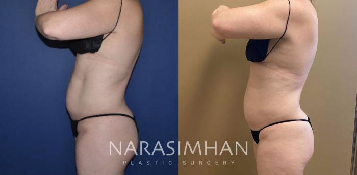 Before & After Coolsculpting Case 263 View #3 View in Tampa, Florida