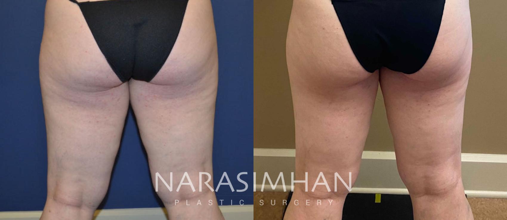 Before & After Coolsculpting Case 263 View #4 View in St Petersburg, Florida