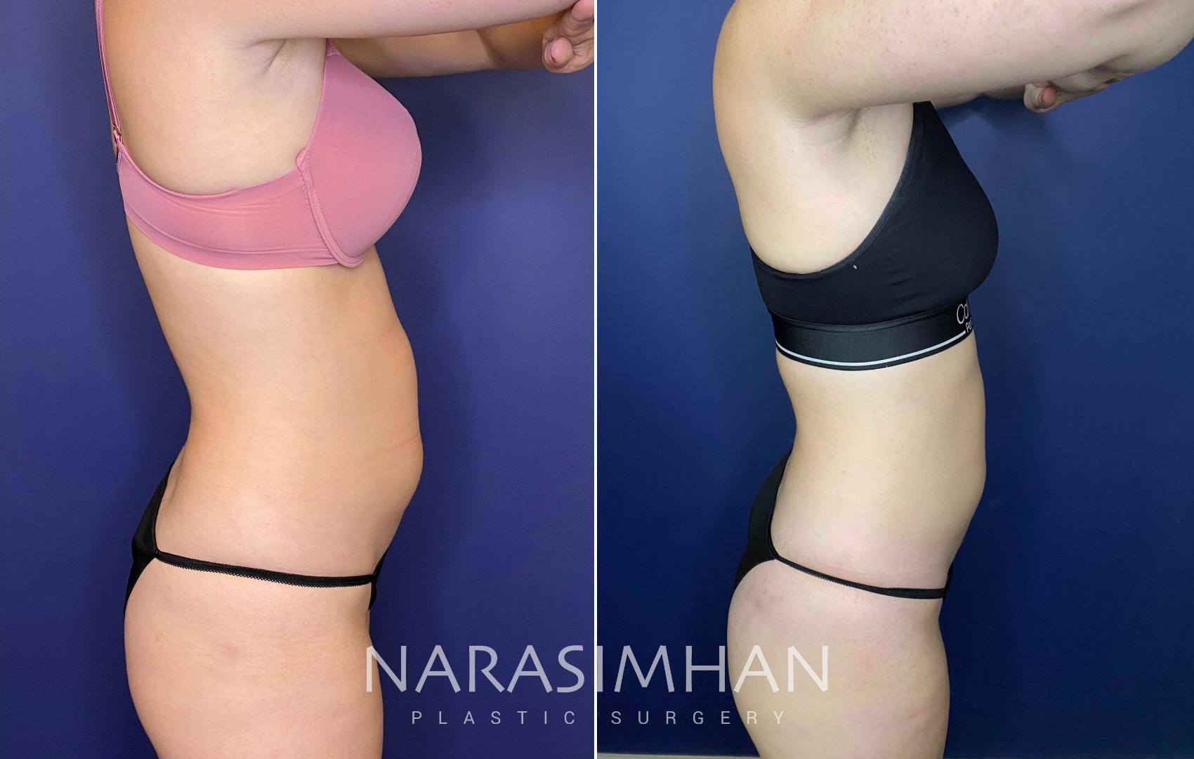 Before & After Coolsculpting Case 266 View #1 View in St. Petersburg, Florida