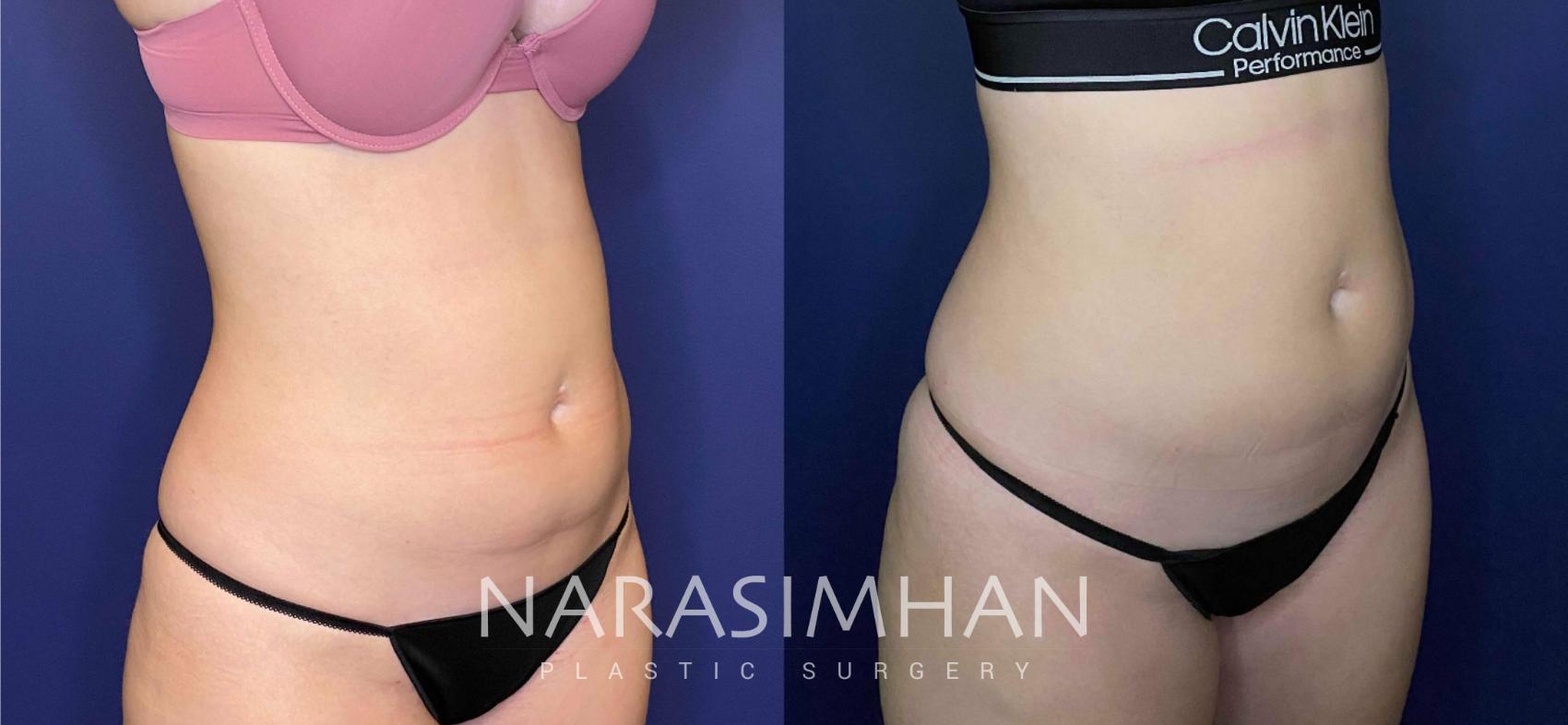 Before & After Coolsculpting Case 266 View #2 View in St Petersburg, Florida