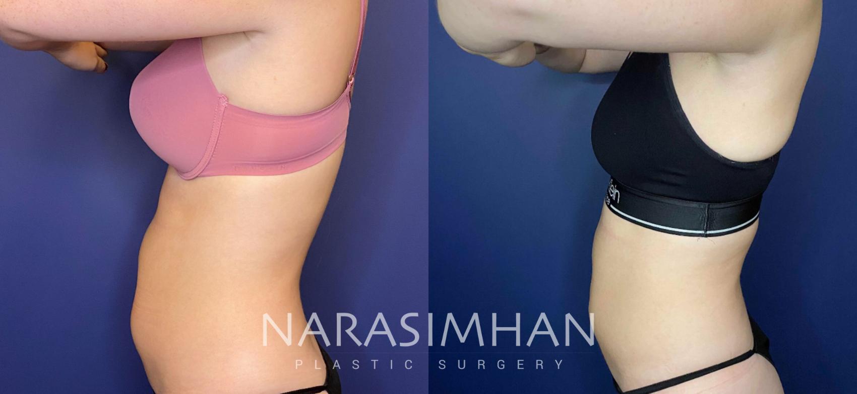Before & After Coolsculpting Case 266 View #3 View in St Petersburg, Florida