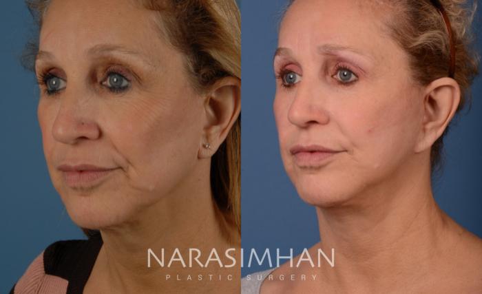 Before & After Necklift Case 106 View #2 View in Tampa, Florida