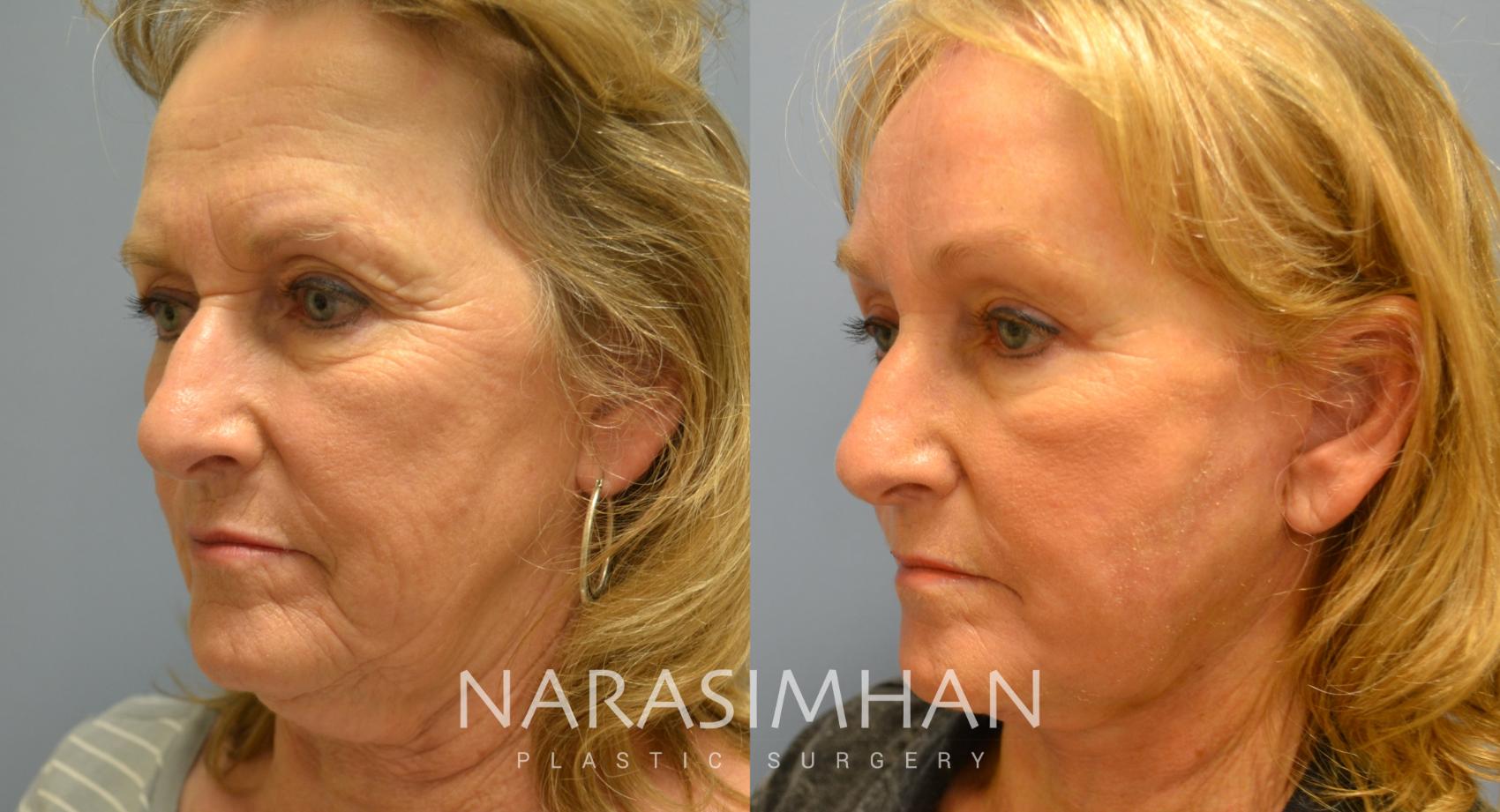 Before & After Facelift Case 11 View #2 View in St Petersburg, Florida