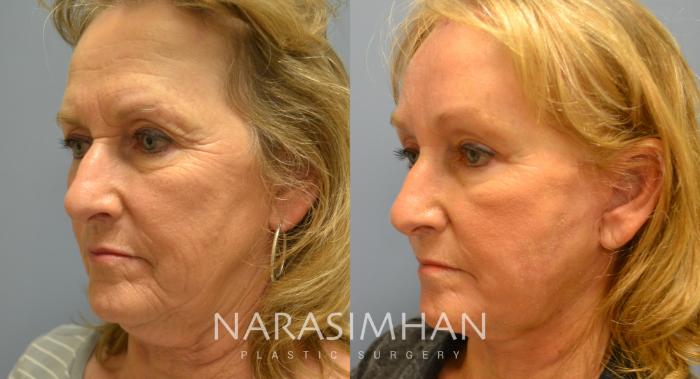 Before & After Facelift Case 11 View #2 View in Tampa, Florida