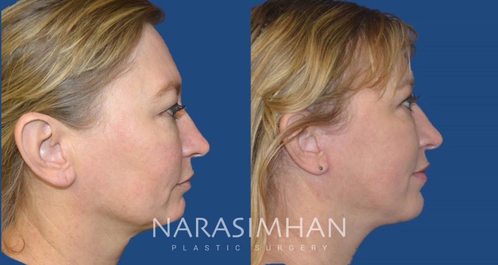 Before & After Necklift Case 110 View #1 View in Tampa, Florida