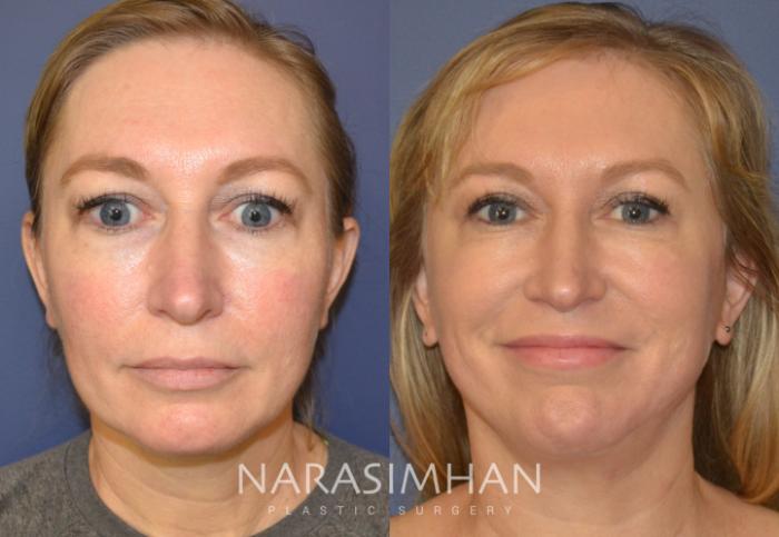 Before & After Facelift Case 110 View #2 View in Tampa, Florida