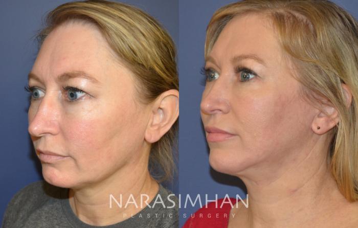 Before & After Facelift Case 110 View #3 View in Tampa, Florida