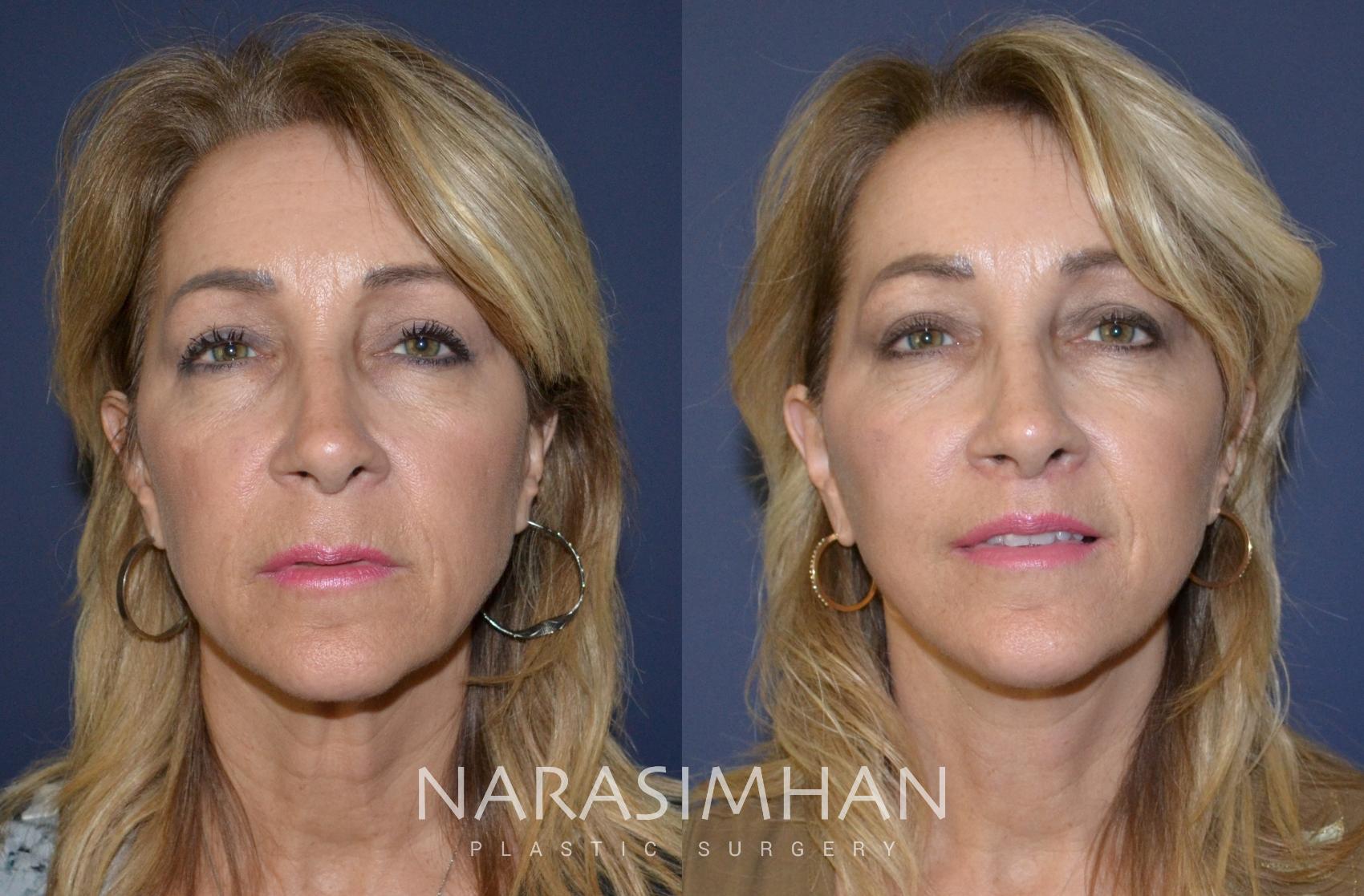 Before & After Facelift Case 125 View #1 View in St Petersburg, Florida