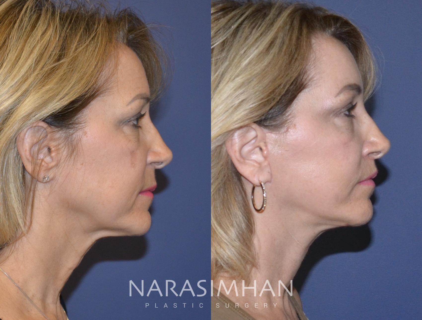 Before & After Facelift Case 125 View #2 View in St Petersburg, Florida