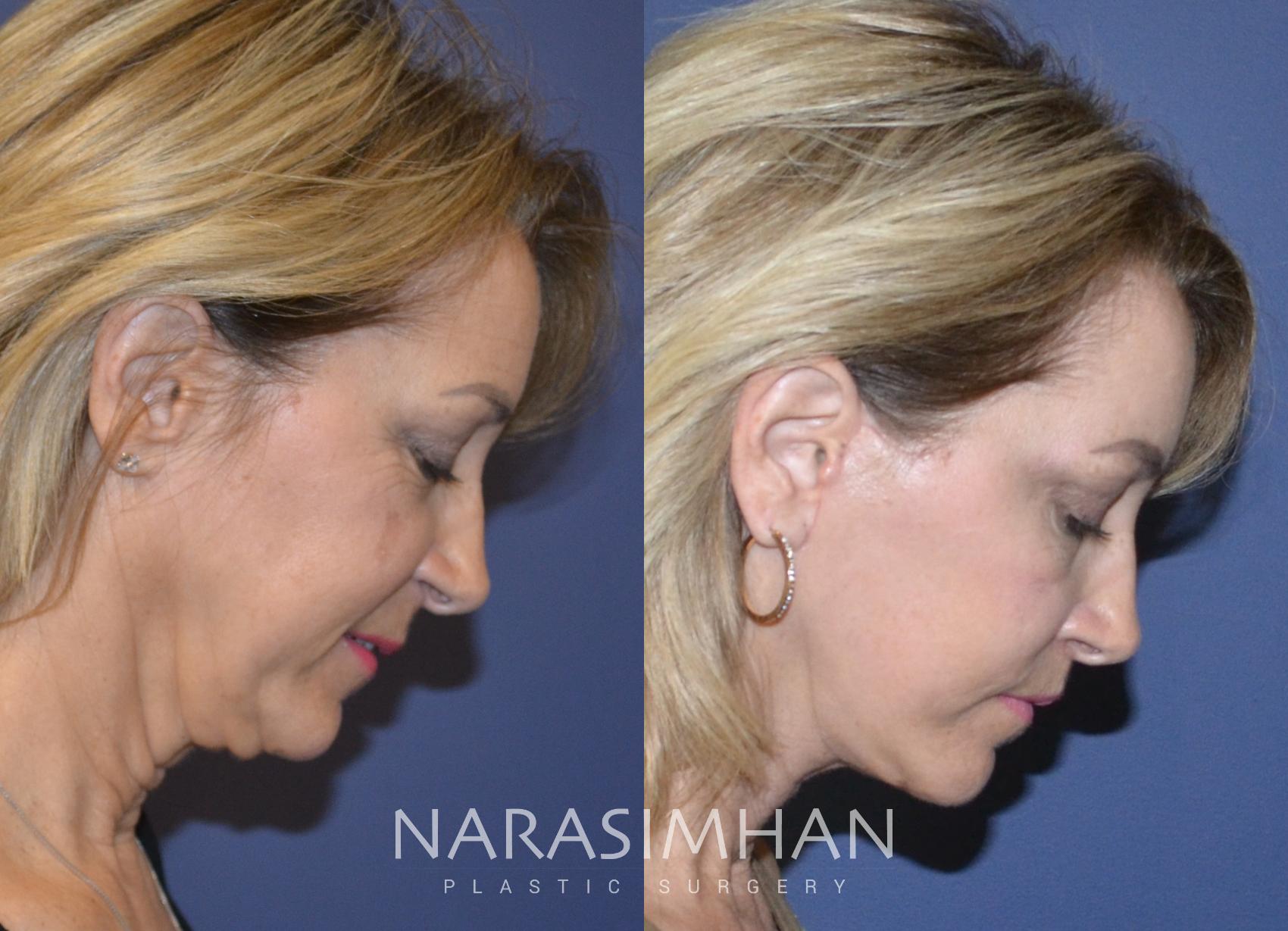Before & After Facelift Case 125 View #3 View in St Petersburg, Florida