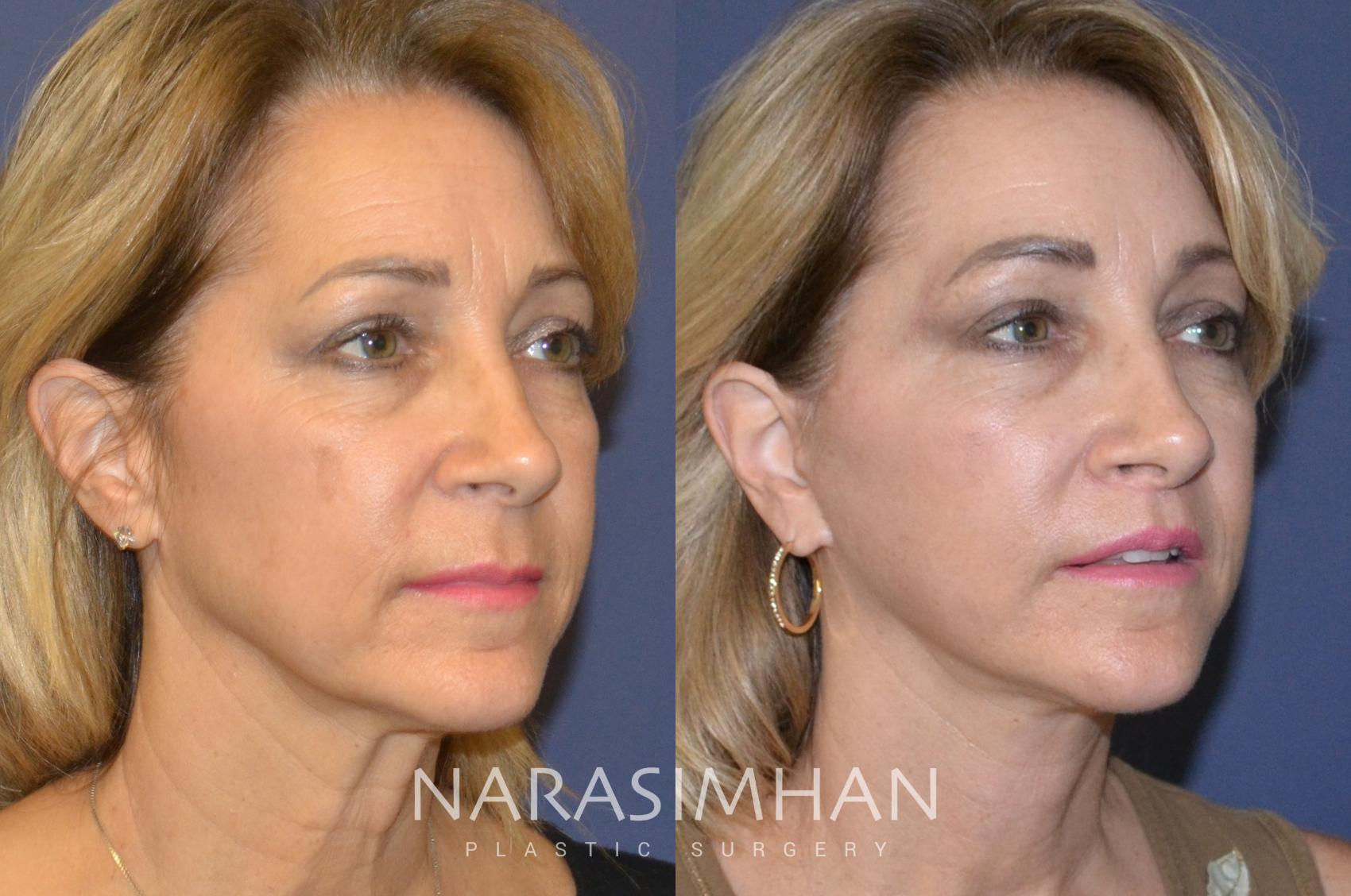 Before & After Facelift Case 125 View #4 View in St Petersburg, Florida