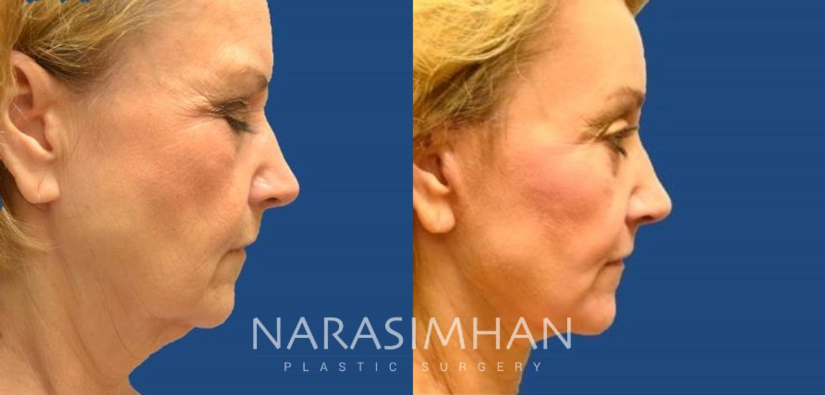 Before & After Necklift Case 15 View #1 View in Tampa, Florida