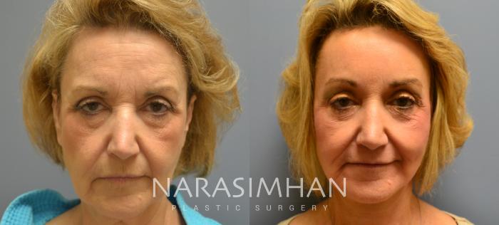 Before & After Necklift Case 15 View #2 View in Tampa, Florida