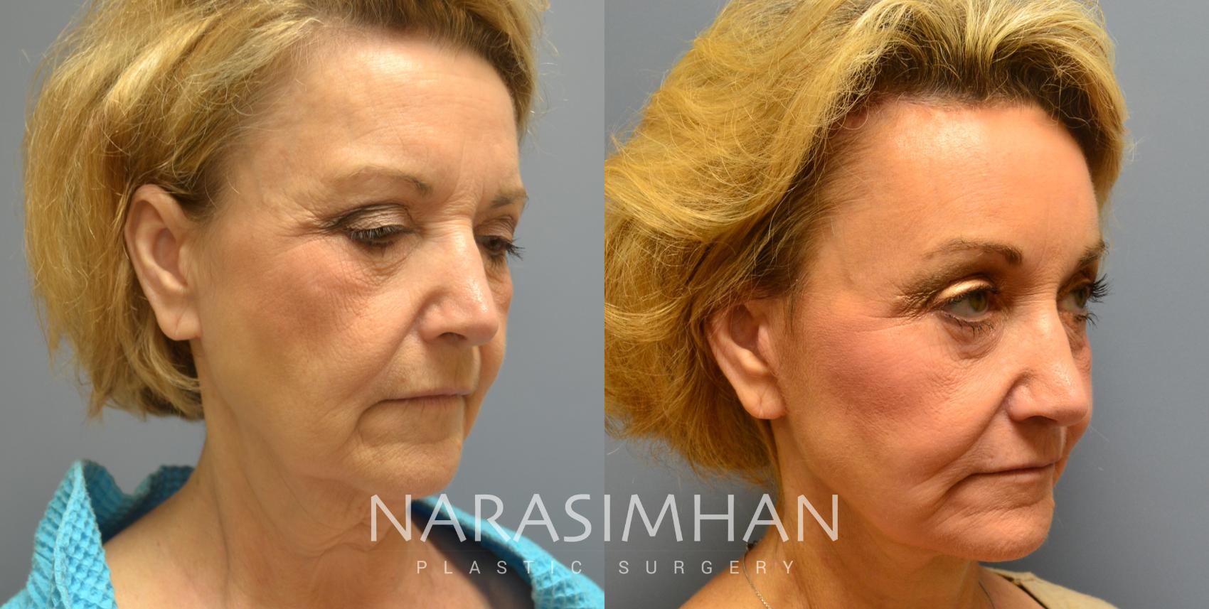 Before & After Facelift Case 15 View #3 View in St Petersburg, Florida
