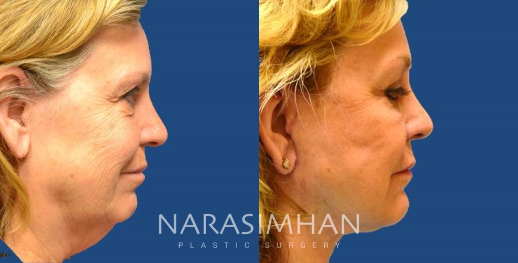 Before & After Necklift Case 20 View #1 View in St Petersburg, Florida