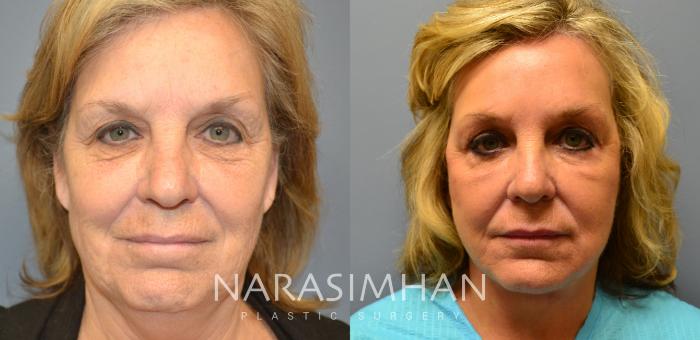 Before & After Browlift Case 20 View #2 View in Tampa, Florida
