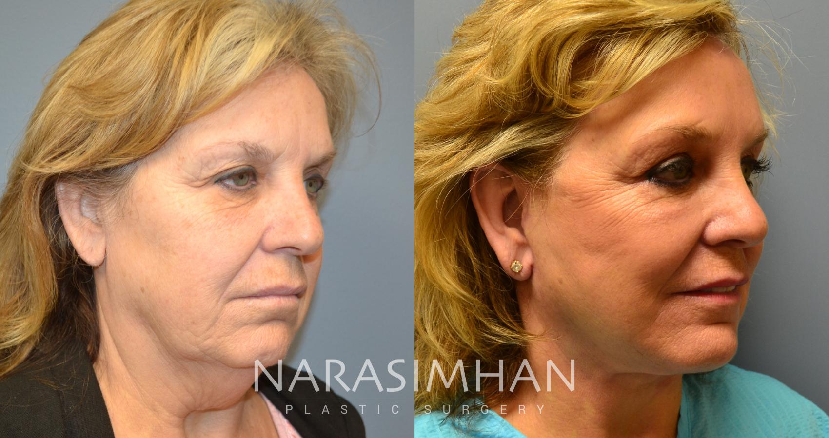 Before & After Facelift Case 20 View #3 View in St Petersburg, Florida