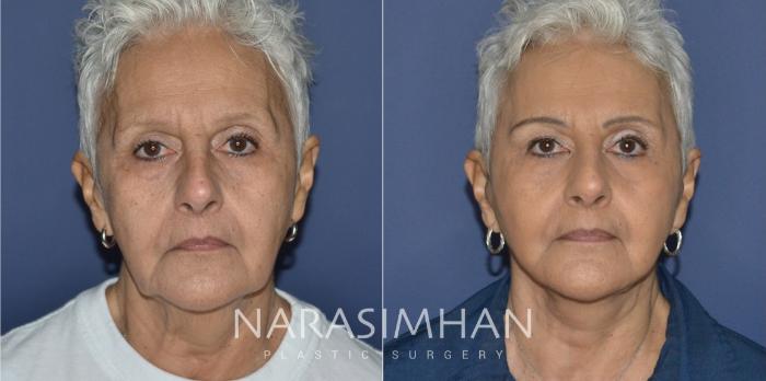 Before & After Facelift Case 210 View #1 View in Tampa, Florida
